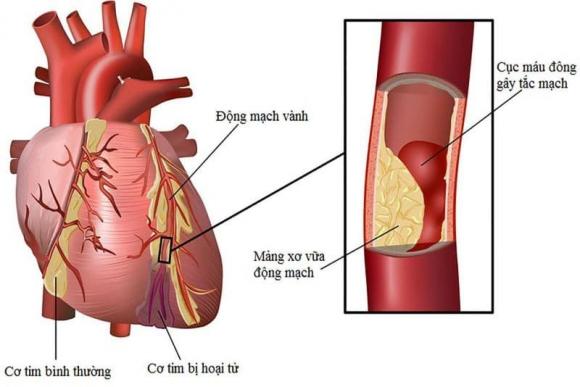 Đức Tiến, Đức Tiến qua đời, nhồi máu cơ tim